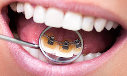 lingual braces