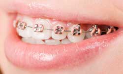 metal braces